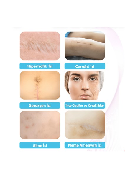 Silikon Yara Izi Bandı 2m – Premium Ameliyat/sezaryen/skar Iz Görünümü Için, Kesilebilir Medikal