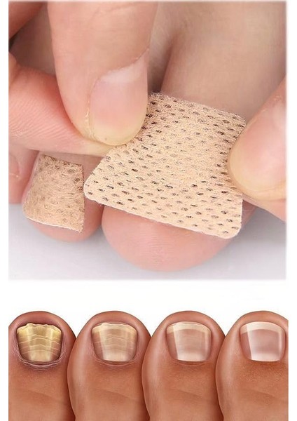 5 Çift Mantar Tırnak Yaması – Ayak ve El Tırnakları Için Güçlü Mantar Tedavisi, Tırnak Yenileyici