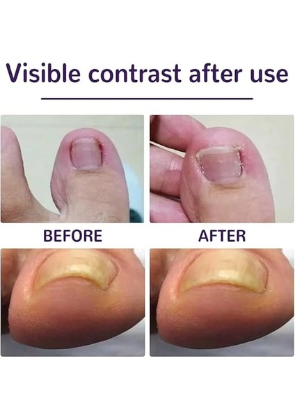 Ayak Tırnağı Düzeltme Bandı 50 Adet fiyatları