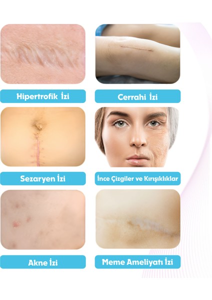 Soft Silikon Bant, Silikonlu Yara İzi Giderici Bandı 3m, Skar Ameliyat Sezeryan Yanık Cerrahi İzler için