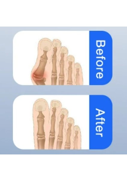 Ayak Baş Parmak Düzeltici Kemik Çıkıntısı Düzeltici Halluks Gece Ateli fırsatları