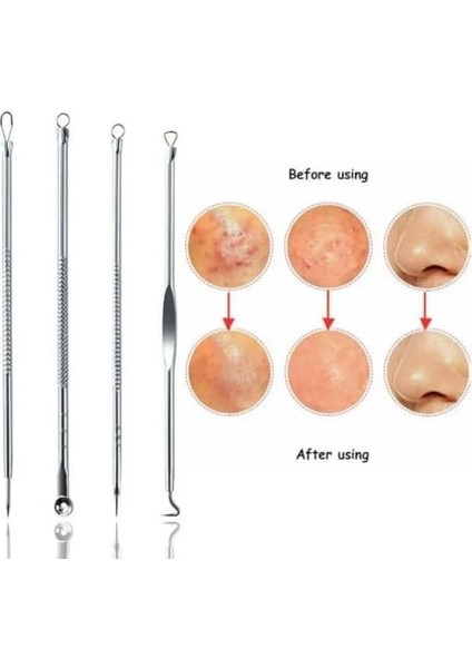 Siyah Nokta Akne Temizleyici 4&apos;lü Kutulu Paslanmaz Komedon Gümüş Komedon Seti Sivilce Siyah Nokta Çıkarıcı Kaliteli fiyatları