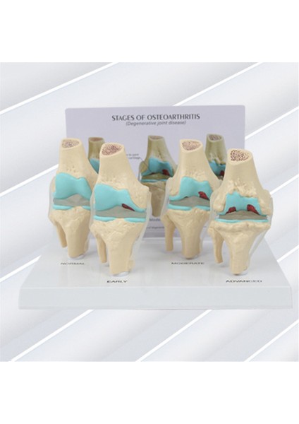 Diz Kiti Osteoartrit Anatomi Modeli Eğitim Anahtar Kart 4 Aşama Diz Modeli Ortopedik Öğretim Yardımcıları (Yurt Dışından) fırsatları
