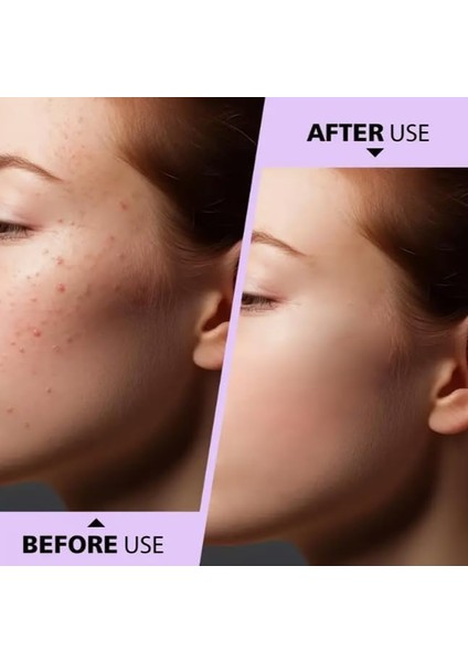 Orret Home 4’lü Paslanmaz Çelik Komedon ve Siyah Nokta Temizleyici Seti – Sivilce, Siğil ve Akne Çıkarıcı Yüz Bakım Aleti, Kutulu Cilt Temizleme Seti, Gümüş Renk fiyatları