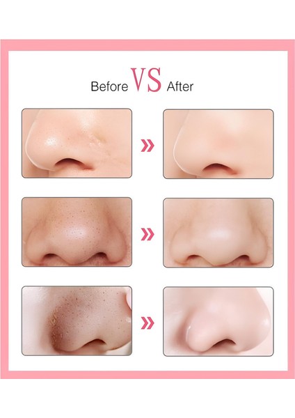 6 Başlıklı Vakumlu Siyah Nokta Temizleyici fırsatları