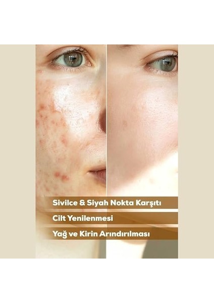 Swelle Doğal Kükürt Sabunu – Yüz ve Vücut Için Sivilce Karşıtı Temizleyici ve Peeling – Siyah Noktalar, Akneyi ve Sebumu Düzenler – Tüm Cilt Tipleri, Erkekler ve Kadınlar modelleri