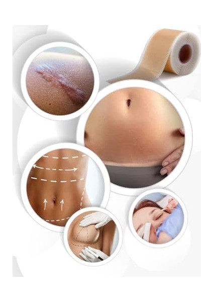 Zonetape Soft Silikon Bant 4cmx1.5mt -Estetik Operasyon- Karın Germe- Sezaryen-Yanık-Ben Aldırma modelleri