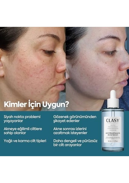 Clasycare Niacinamide Akne Karşıtı Serum – Gözenek Sıkılaştırıcı, Yağ Dengesi ve Cilt Aydınlatıcı Serum – Siyah Nokta ve Leke Karşıtı Yüz Serumu, 50 ml modelleri