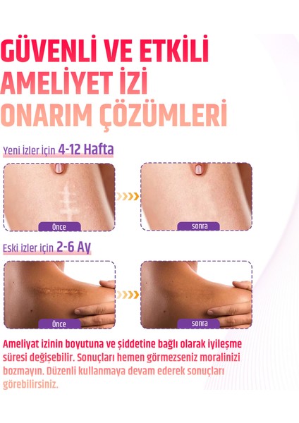 Silikon Yara Izi Bandı 2,5 M Skar Azaltıcı Soft Medikal Silikon Bant – Ameliyat/sezaryen/yanık/akne Izleri Için fırsatları
