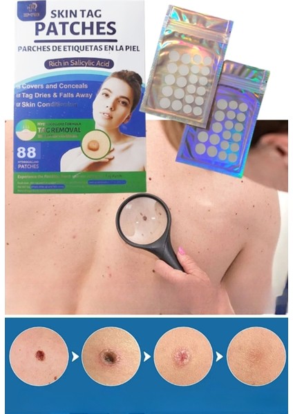 Skin Tag Remover 88 Adet Leke Karşıtı Dökücü Yokedici Bant Sıgıl Et Beni Giderici fiyatları
