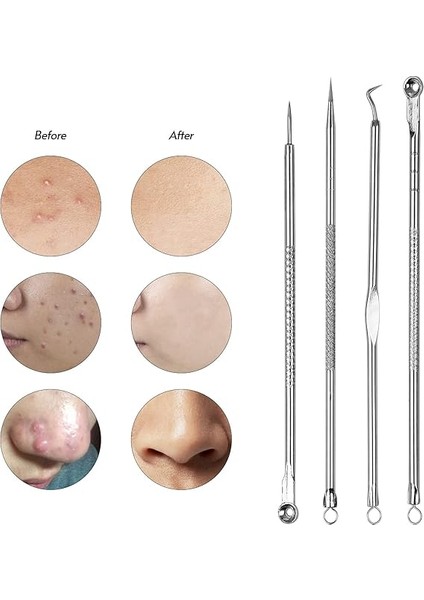 Siyah Nokta Çıkarıcı Aracı Siyah Nokta Remover Sivilce Popper Sivilce Leke Için Araç Kiti Komedone Akne Zit Whitehead Yüz Çene Noze Alın Yanak Vücut fırsatları
