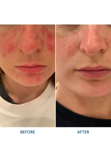 Aktif Özler Içeren Akne Jeli 30G ve Kızarıklık Karşıtı fiyatları