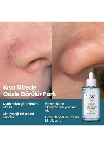 Clasycare Niacinamide Akne Karşıtı Serum – Gözenek Sıkılaştırıcı, Yağ Dengesi ve Cilt Aydınlatıcı Serum – Siyah Nokta ve Leke Karşıtı Yüz Serumu, 50 ml