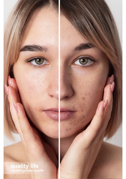 Akne ve Sivilce Karşıtı Serum Sebum Dengeleyici Siyah Nokta Önleyici Leke Karşıtı Gözenek Sıkılaştırıcı Sivilce Önleyici Krem