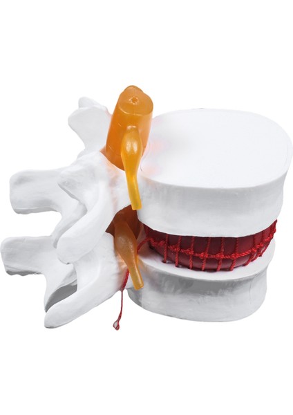 1 Pcs Omurga Lomber Disk Herniasyon Öğretim Modeli ve 1 Pcs Insan Anatomisi Omurga Vertebral Model (Yurt Dışından) fiyatları