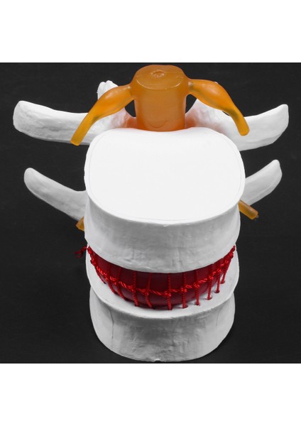 1 Pcs Omurga Lomber Disk Herniasyon Öğretim Modeli ve 1 Pcs Insan Anatomisi Omurga Vertebral Model (Yurt Dışından) modelleri