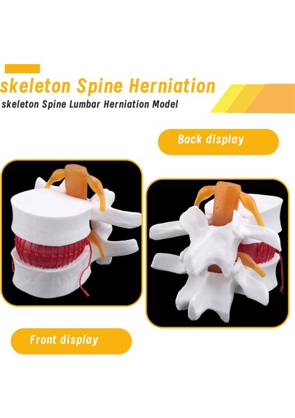 Insan Anatomisi Omurga Lomber Disk Herniasyon Öğretim Modeli Beyin Kafatası Travmatik Okul Malzemeleri Enstrüman (Yurt Dışından) modelleri