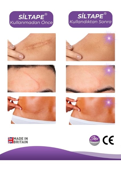 UK Siltape Soft Silikon Bant -dikiş izi-sezaryen-yanık-estetik 2cm x 3mt modelleri