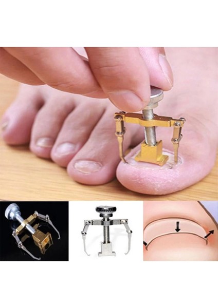 Batık Tırnak Çıkarma Aparatı fırsatları