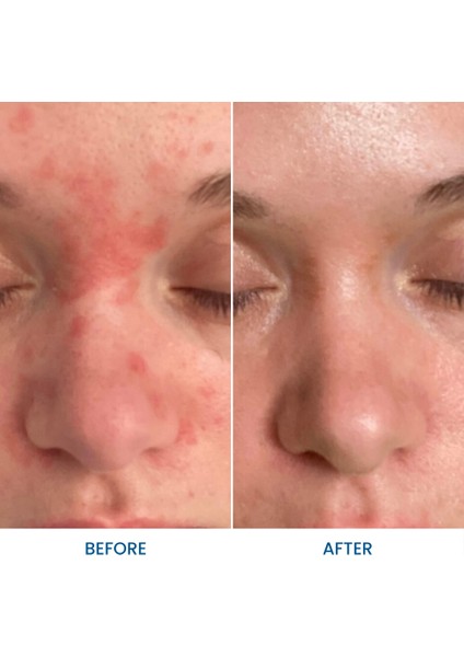 Kızarıklık Karşıtı Yüz Yıkama Jeli 125ML Sabunsuz modelleri