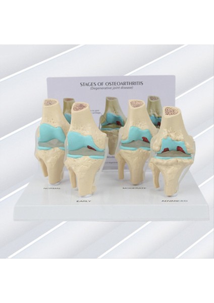 Diz Kiti Osteoartrit Anatomi Modeli Eğitim Anahtar Kart 4 Aşama Diz Modeli Ortopedik Öğretim Yardımcıları (Yurt Dışından) fırsatları