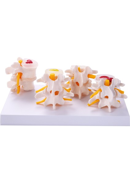 Insan Anatomisi Omurga 4 Aşama Lomber Vertebral Model Beyin Kafatası Travmatik Öğretim Malzemeleri (Yurt Dışından)