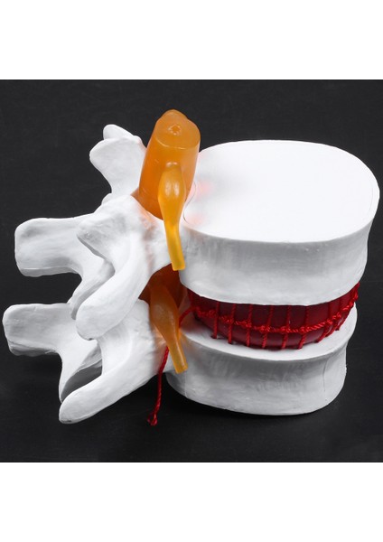 1 Pcs Omurga Lomber Disk Herniasyon Öğretim Modeli ve 1 Pcs Insan Anatomisi Omurga Vertebral Model (Yurt Dışından) fırsatları