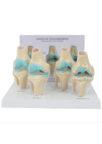 Diz Kiti Osteoartrit Anatomi Modeli Eğitim Anahtar Kart 4 Aşama Diz Modeli Ortopedik Öğretim Yardımcıları (Yurt Dışından)