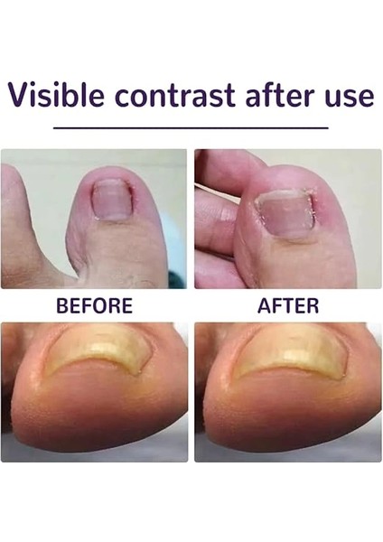 Ayak Tırnağı Düzeltme Bandı 50 Adet fiyatları