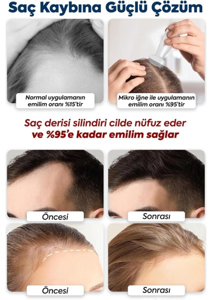120 Titanyum Iğneli Ayarlanabilir Iğne Ölçülü (0.25-2.0mm) Dermastamp Derma Stamp Dermaroller Roller fiyatları