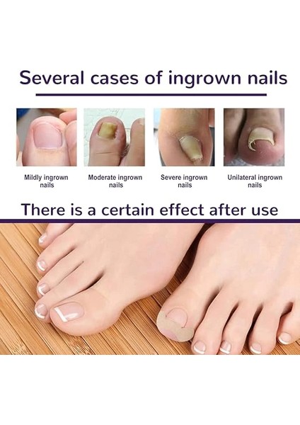 Ayak Tırnağı Düzeltme Bandı 50 Adet modelleri