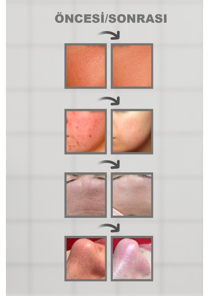 Ultrasonik Yüz Temizleme Cihazı Scrubber | Siyah Nokta Akne Peeling Lifting Nemlendirme Aleti