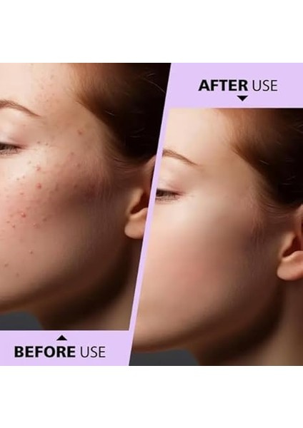 4'lü Kutulu Paslanmaz Çelik Komedon Akne Siyah Nokta Sivilce Siğil Temizleyici Çıkarıcı Seti Gümüş modelleri