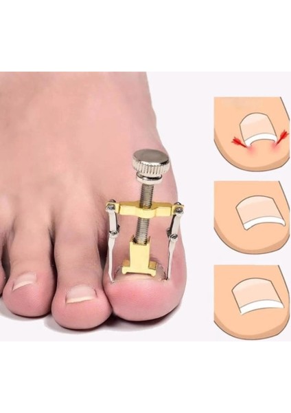 Batık Tırnak Çıkarma Aparatı modelleri