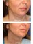 Dr Lipo Mezoterapi Gıdı Eritme, Yanak Inceltme [1 Flakon 5ml Fiyatıdır] 4