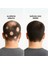 Alopesi Areata(Saçkıran) Destek Seti 3