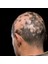 Alopesi Areata(Saçkıran) Destek Seti 5