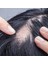 Alopesi Areata(Saçkıran) Destek Seti 7