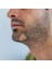 Alopesi Areata(Sakal Kıran) Destek Seti 3