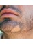 Alopesi Areata(Sakal Kıran) Destek Seti 4