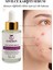 Akne ve Karşıtı Serum - Akne Kurutucu - Siyah Nokta Leke Iz Akne Komedon Karşıtı 2