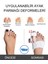 Halluks Valgus Splinti Pratik Sistemli (Tek) W656 3