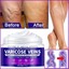 Maximum Strength Varicose Veins Krem 100 ml 1 Adt 2